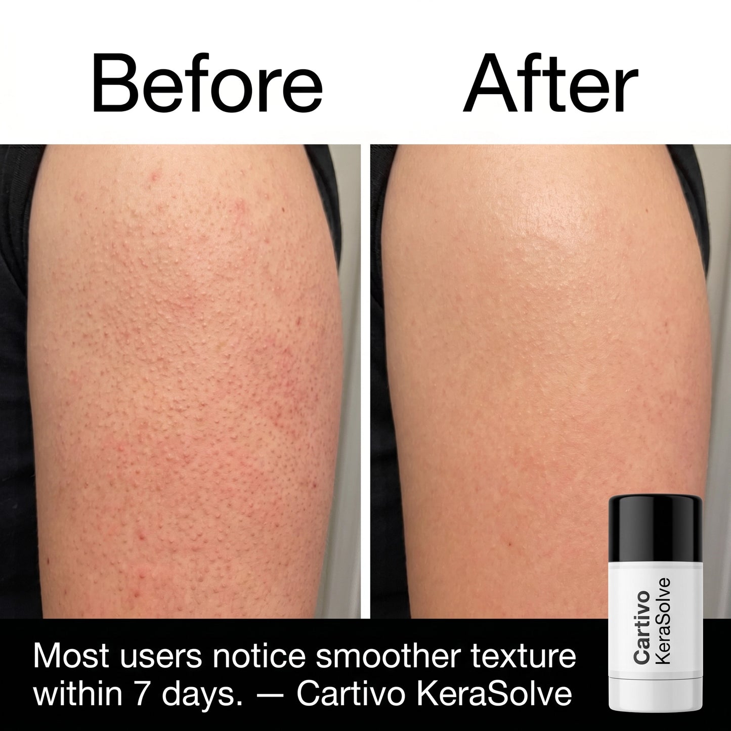 Cartivo KeraSolve™ Body Stick